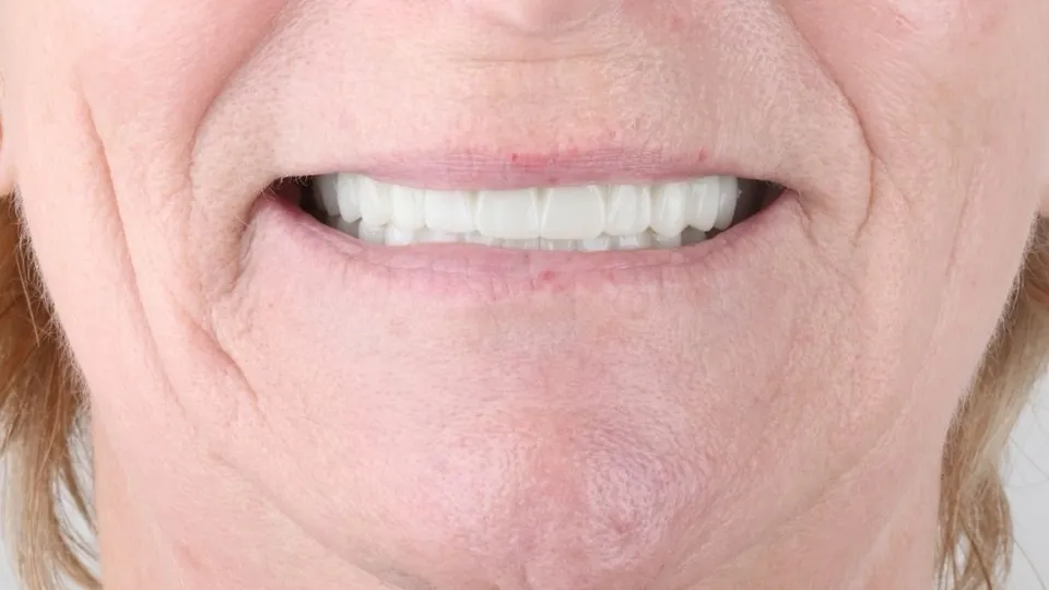 Улыбка пациентки после лечения в Phinova Clinics